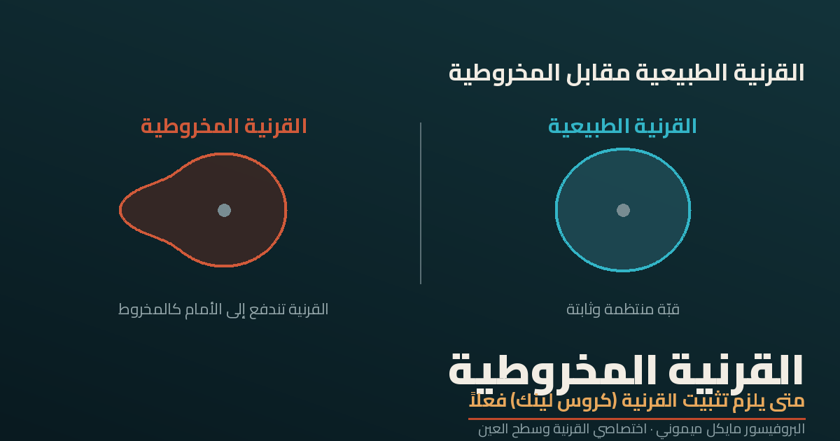 القرنية المخروطية وتثبيت القرنية (كروس لينك)