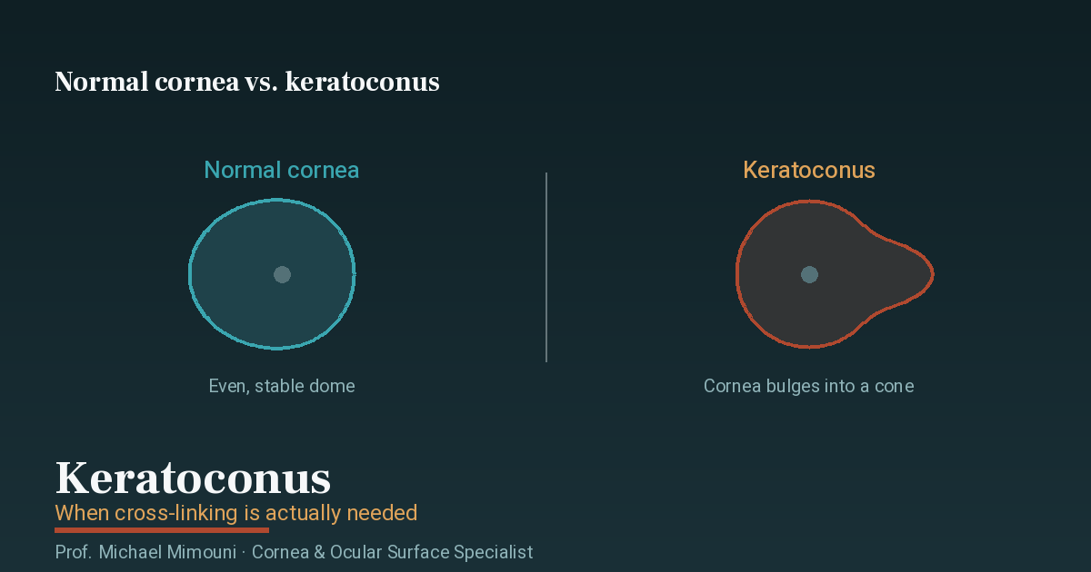 Keratoconus and Cross-Linking