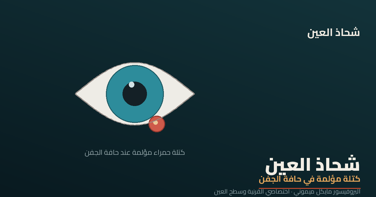 شحاذ العين